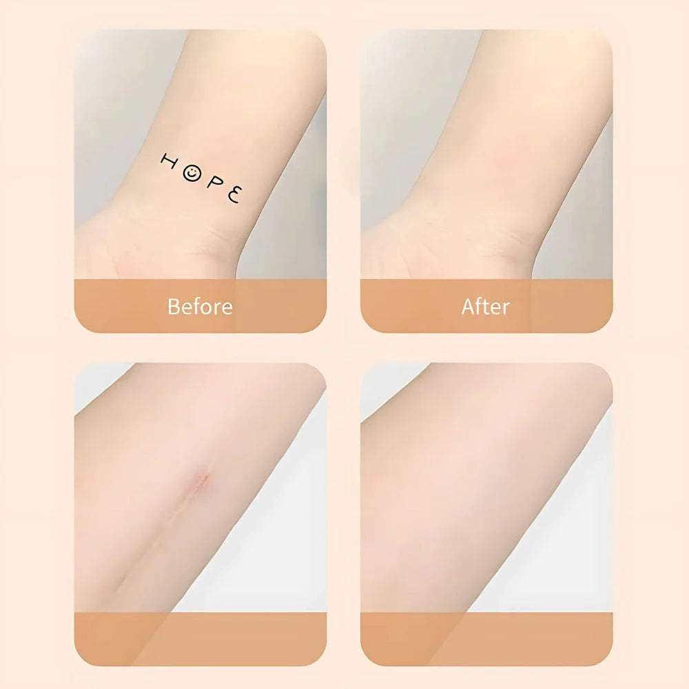 Kalsten | Scar Concealer Patch Waterproof Skin Cover 4